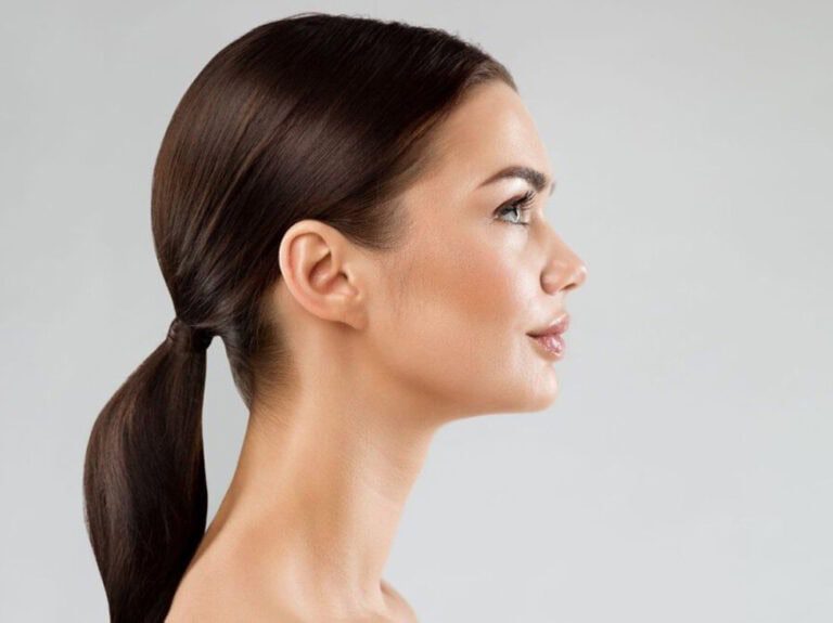 Paciente femenina después de una rinoplastia