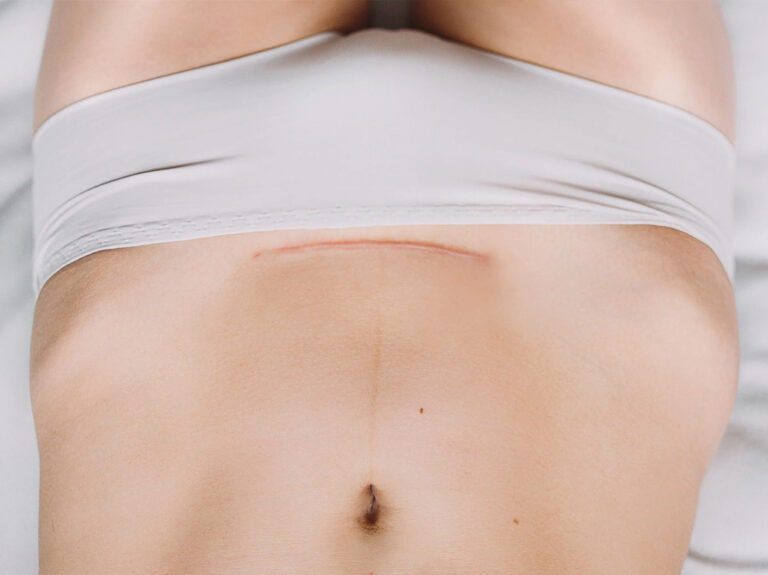 paciente femenina que busca cuidar su cicatriz de un procedimiento de cirugía plástica en el abdomen