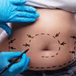 Marcas que se realizan previas aun a liposuccion