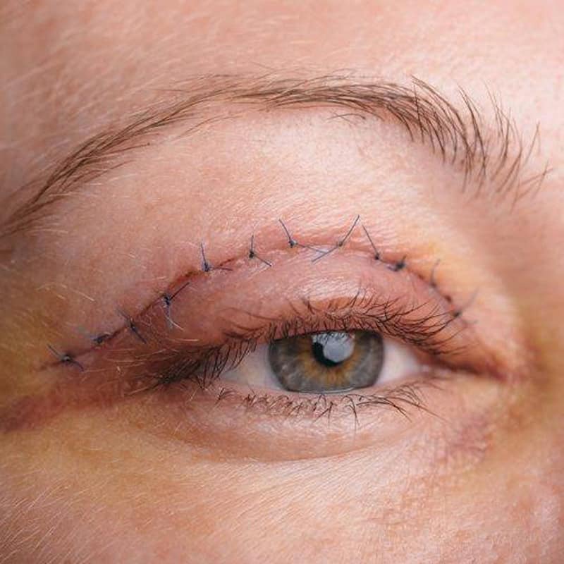 ojo derecho de una paciente femenina con las cicatrices de una blefaroplastia