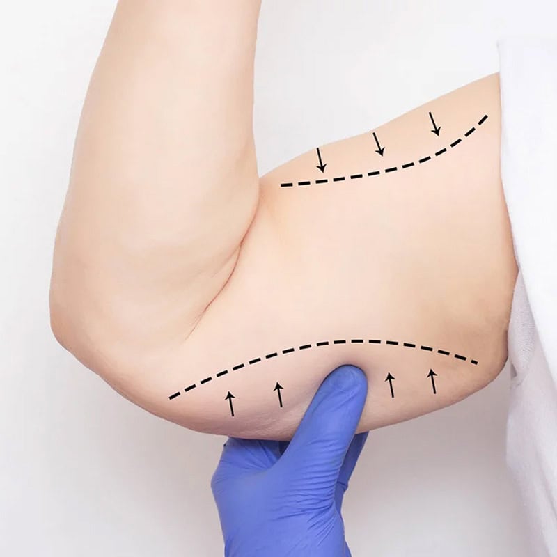 brazo derecho paciente femenina antes de realizarse un procedimiento de braquiplastia