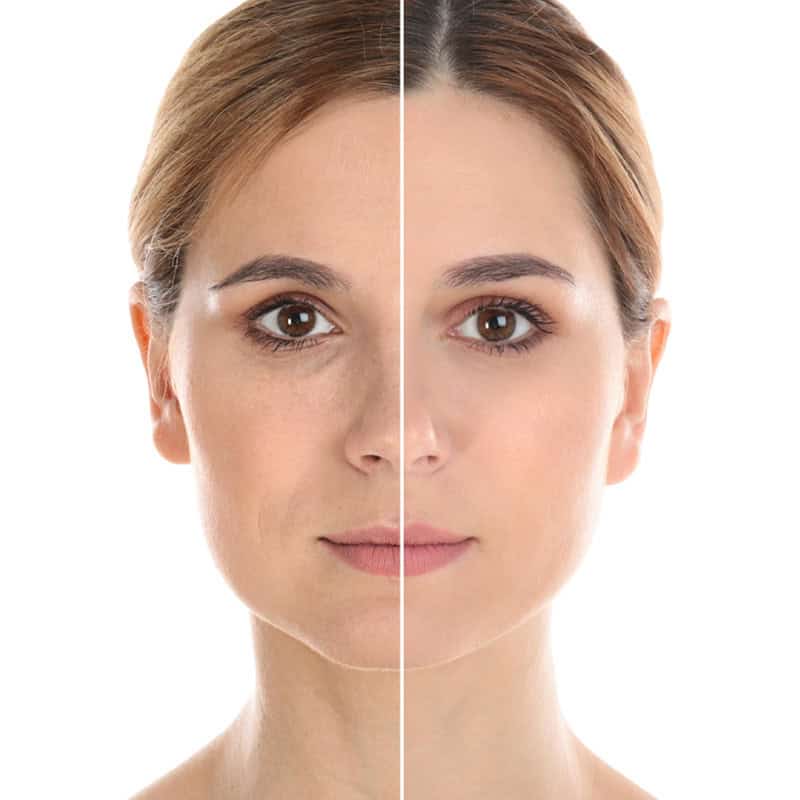 paciente femenina antes y después de un procedimiento de lifting facial