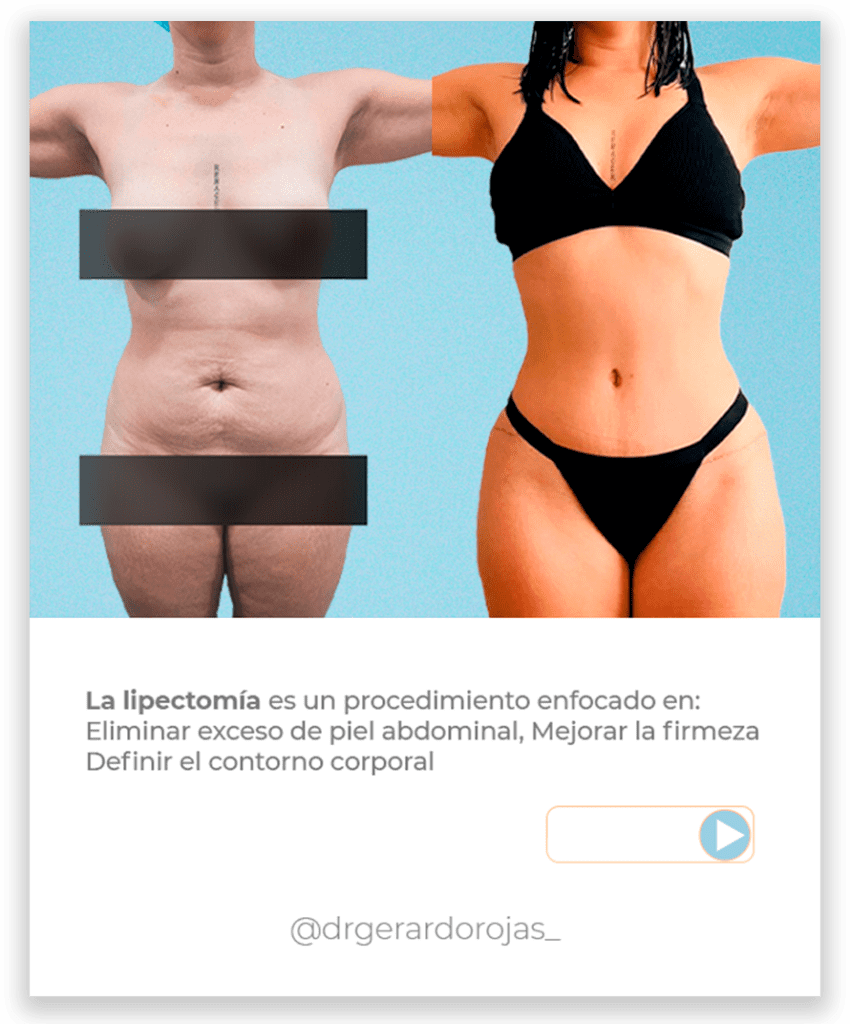 La lipectomía es un procedimiento enfocado en:Eliminar exceso de piel abdominal
Mejorar la firmeza
Definir el contorno corporal