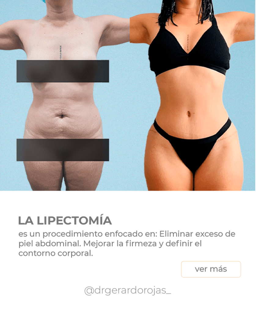 LIPECTOMÍA01